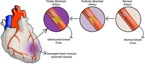 Acute Myocardial Infarction Acute Myocardial Infarction